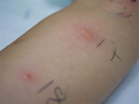 skin allergy test philippines cost|Alamin: Mga skin test para sa allergy .